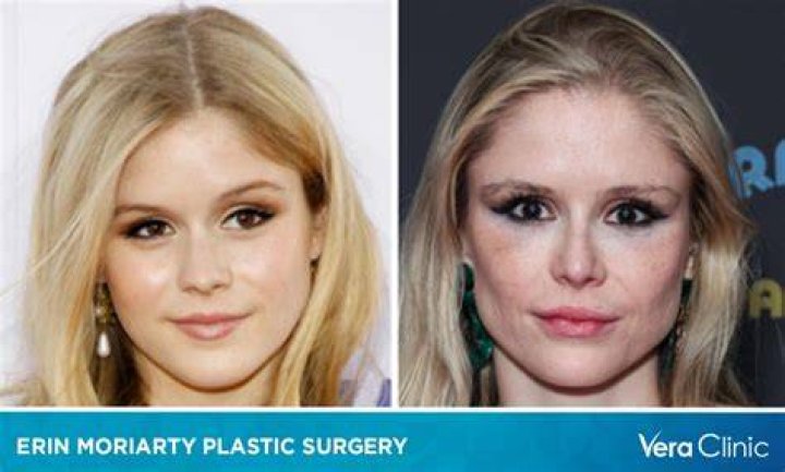Unveiling the Truth Behind Tim Henson's Plastic Surgery Rumors